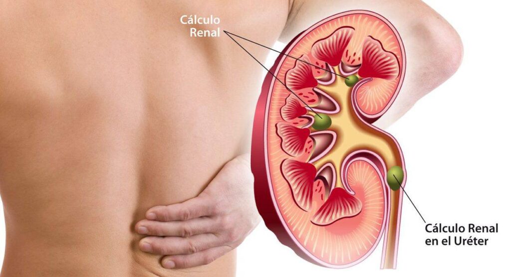 Imagen de un riñón con cálculo renal en su interior y en el uréter, que produce dolor 