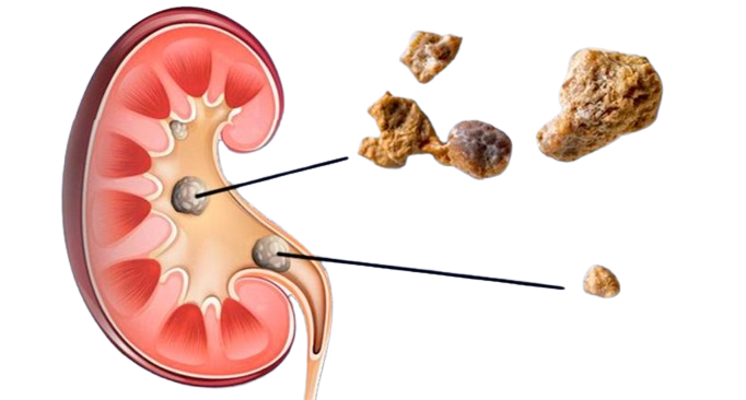 Imagen de un hígado con piedras
